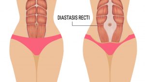 Do you know any reconstructive surgeons for diastasis recti?